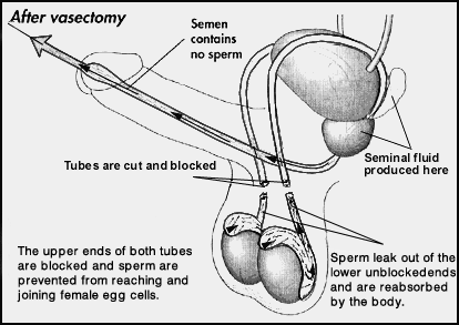 About Vasectomy - My Vasectomy